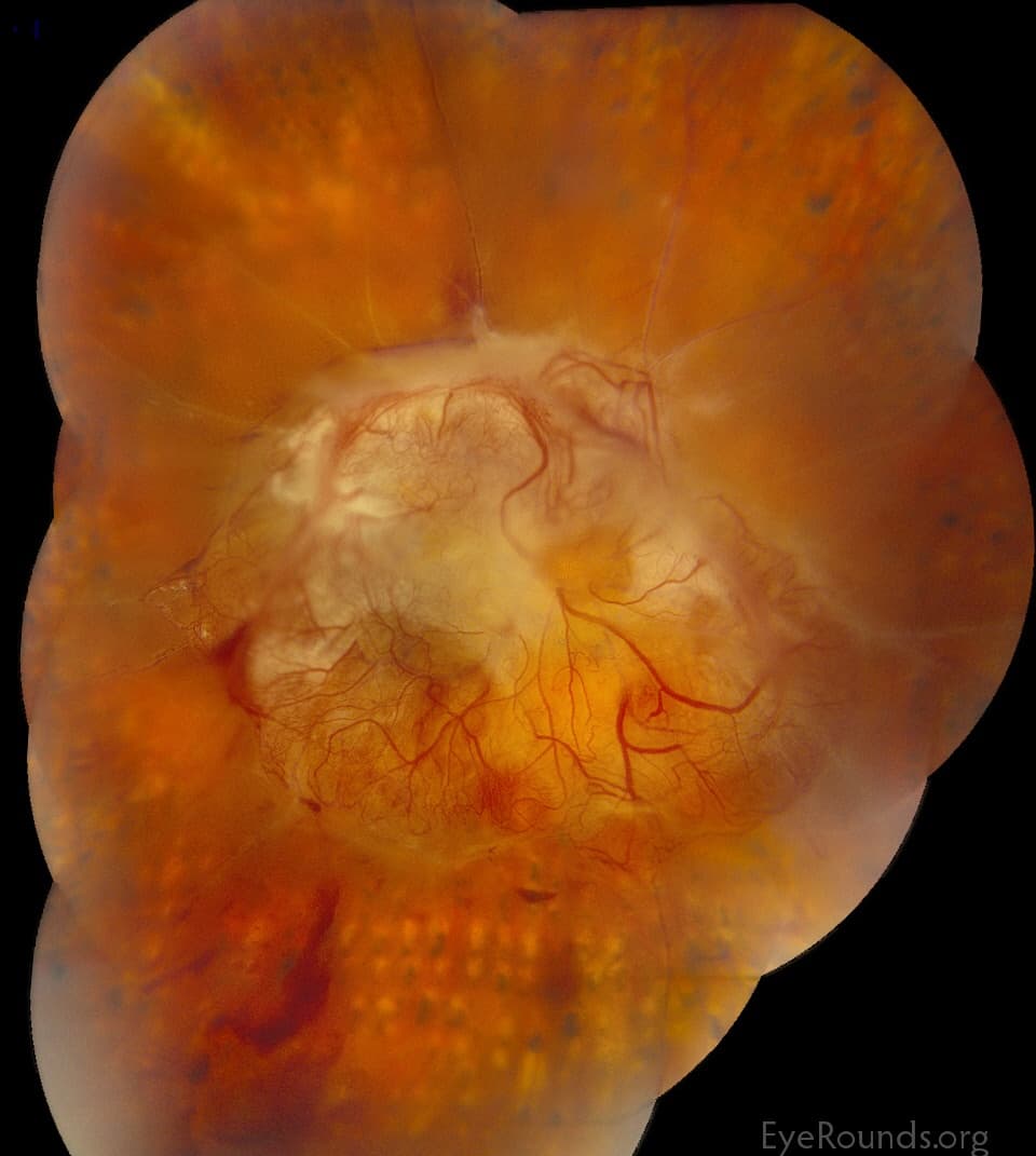Clinical ophthalmic photograph of severe proliferative diabetic retinopathy - vitreous condition