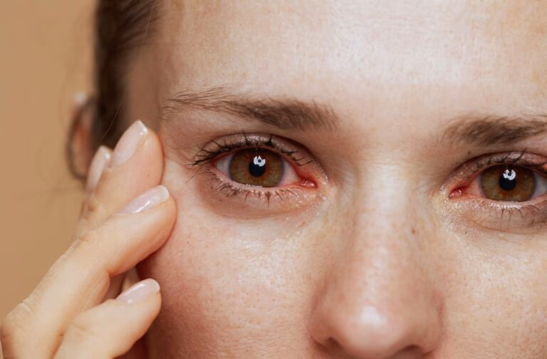 Dry Eye Syndrome: Why Over-the-Counter Drops Aren't Enough