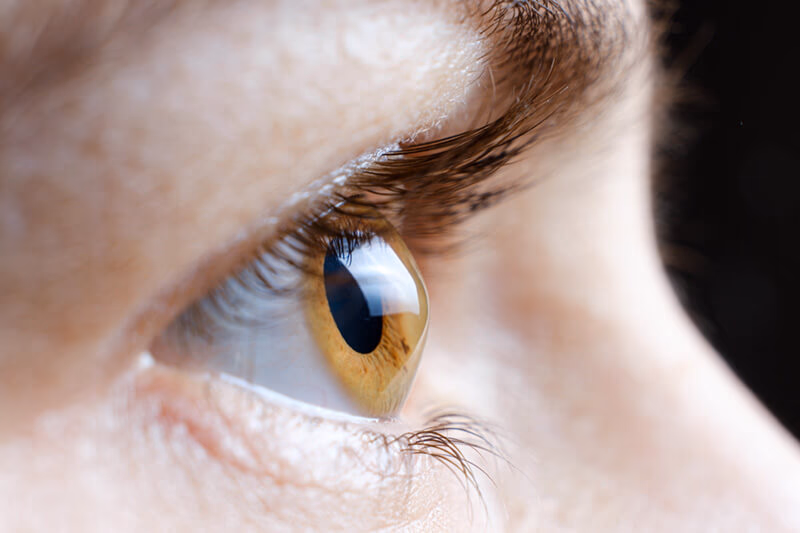 Living with Keratoconus: A Comprehensive Patient's Guide